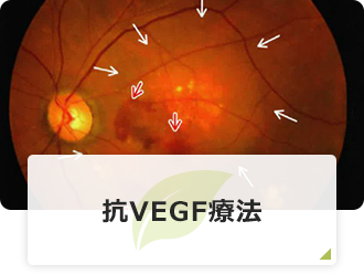 抗VEGF療法