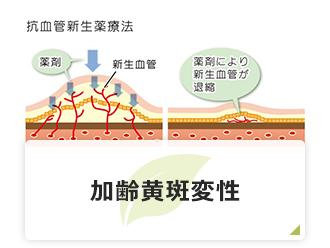 加齢黄斑変性