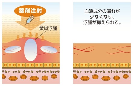 抗VEGF薬治療（硝子体内注射） 当院ではルセンティス・アイリーアを使用しております