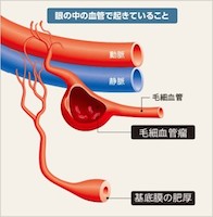 糖尿病網膜症（糖尿病黄斑浮腫）とは