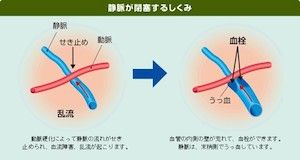 網膜静脈閉塞症とは