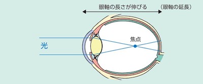 強度近視（病的近視）とは